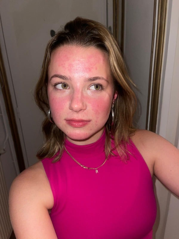 Can I develop Asian Glow?